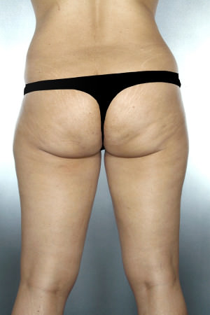 Liposuction Before & After Patient #8654