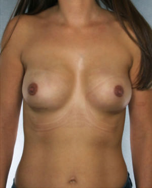 Breast Reconstruction Before & After Patient #8332