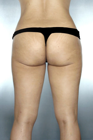 Liposuction Before & After Patient #8654