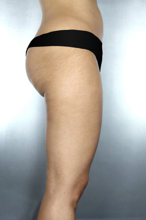 Liposuction Before & After Patient #8654