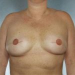 Breast Reconstruction Before & After Patient #9380