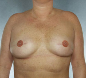 Breast Reconstruction Before & After Patient #9380