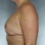 Breast Reconstruction Before & After Patient #9380