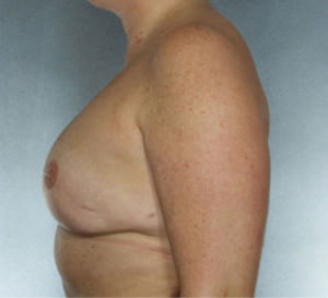 Breast Reconstruction Before & After Patient #9380