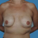 Breast Reconstruction Before & After Patient #9375