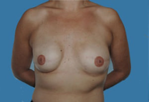 Breast Reconstruction Before & After Patient #9375