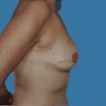 Breast Reconstruction Before & After Patient #9375