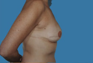 Breast Reconstruction Before & After Patient #9375