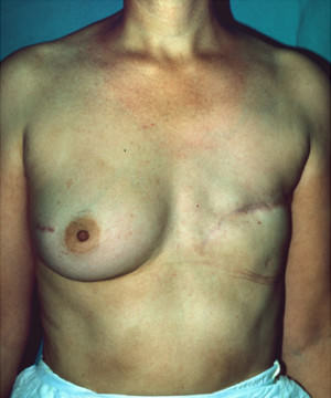 Breast Reconstruction Before & After Patient #8342