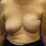 Breast Reconstruction Before & After Patient #8342