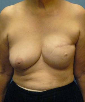 Breast Reconstruction Before & After Patient #8342