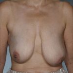Breast Reconstruction Before & After Patient #8345