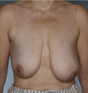 Breast Reconstruction Before & After Patient #8345