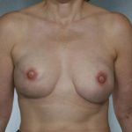 Breast Reconstruction Before & After Patient #8345