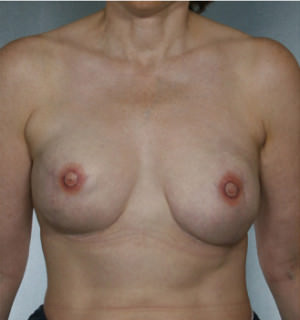 Breast Reconstruction Before & After Patient #8345