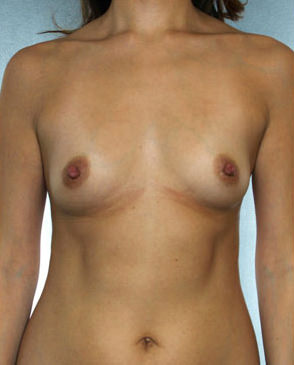 Breast Augmentation Before & After Patient #8069