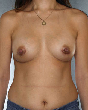 Breast Augmentation Before & After Patient #8069
