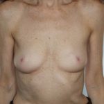 Breast Augmentation Before & After Patient #8079
