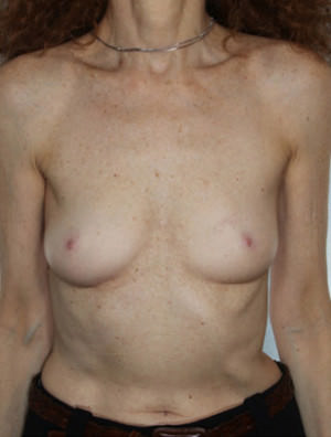 Breast Augmentation Before & After Patient #8079