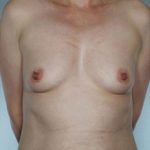 Breast Augmentation Before & After Patient #8084