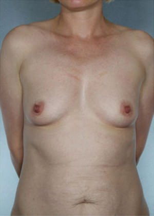Breast Augmentation Before & After Patient #8084
