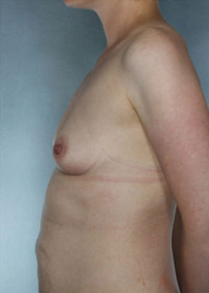 Breast Augmentation Before & After Patient #8084