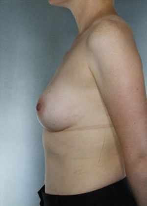 Breast Augmentation Before & After Patient #8084