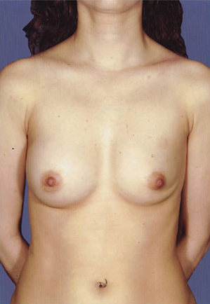 Breast Augmentation Before & After Patient #8089