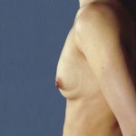 Breast Augmentation Before & After Patient #8089