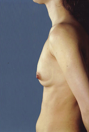 Breast Augmentation Before & After Patient #8089