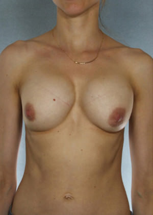 Breast Augmentation Before & After Patient #8099