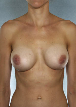 Breast Augmentation Before & After Patient #8099