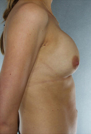 Breast Augmentation Before & After Patient #8099
