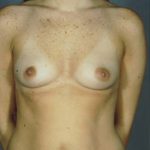 Breast Augmentation Before & After Patient #8104