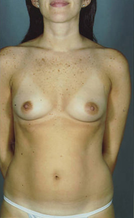 Breast Augmentation Before & After Patient #8104