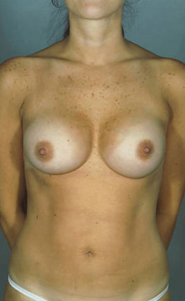 Breast Augmentation Before & After Patient #8104