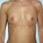 Breast Augmentation Before & After Patient #8114