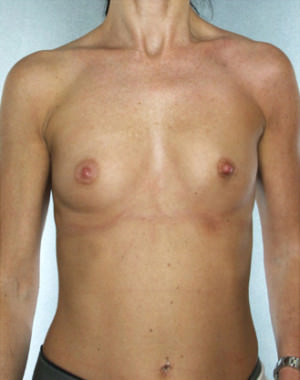 Breast Augmentation Before & After Patient #8114