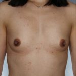 Breast Augmentation Before & After Patient #8119