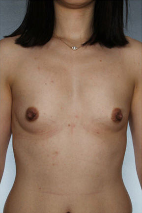 Breast Augmentation Before & After Patient #8119