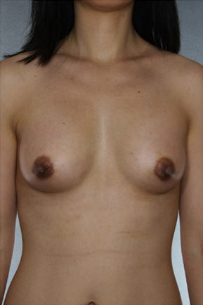 Breast Augmentation Before & After Patient #8119