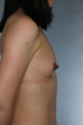 Breast Augmentation Before & After Patient #8119