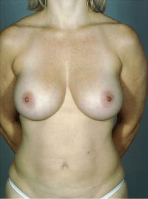 Breast Augmentation Before & After Patient #8124