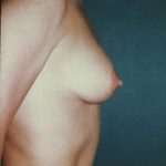 Breast Augmentation Before & After Patient #8129