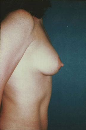 Breast Augmentation Before & After Patient #8129