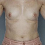 Breast Augmentation Before & After Patient #8134