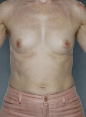 Breast Augmentation Before & After Patient #8134