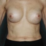 Breast Augmentation Before & After Patient #8134