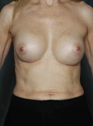 Breast Augmentation Before & After Patient #8134