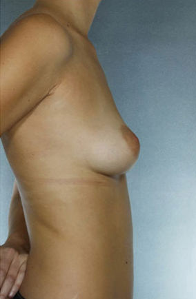 Breast Augmentation Before & After Patient #8139